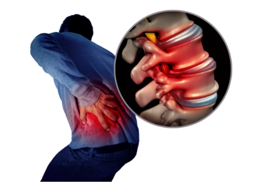 Lower Back Pain